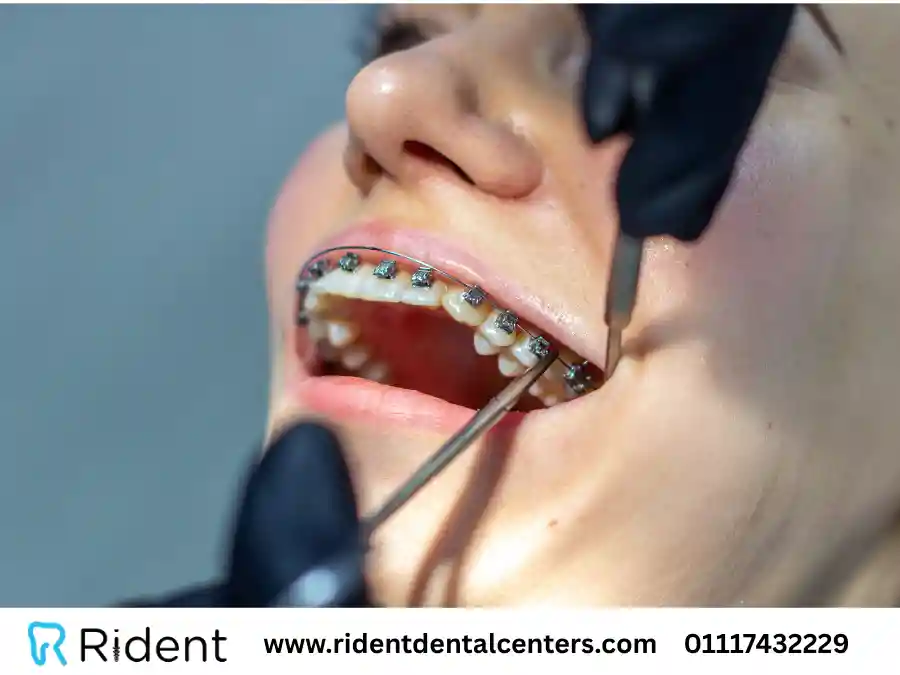 سعر تقويم الأسنان في السعودية 2025